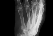 Osteoporose, doença da mulher mais velha?