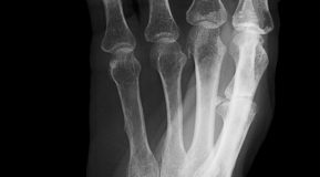 Osteoporose, doença da mulher mais velha?